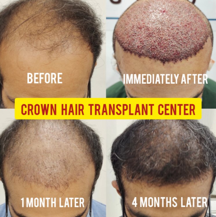 Crown Hair Transplant Clinic in Tamil Nadu, India
