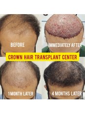 Hair Transplant - Crown Hair Transplant Clinic