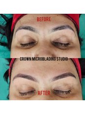 Microblading - Crown Hair Transplant Clinic