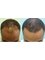 Artistic Hair Transplant Centre - Before & After 1 year  