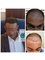 Artistic Hair Transplant Centre - Before & After one year  