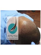 FUE - Follicular Unit Extraction - Artistic Hair Transplant Centre