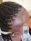 Artistic Hair Transplant Centre - How hairline finishing 