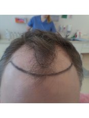 Hair Transplant FUE - Hair Transplant Clinic Rubenhair Latvia