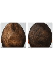 Treatment for Male Pattern Baldness - Hair Transplant Clinic Rubenhair Latvia