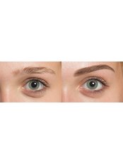 Eyebrow correction FUE - Hair Transplant Clinic Rubenhair Latvia