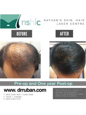 Hair Transplant - Dr Ruban’s Skin & Hair Clinic