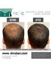 Treatment for Male Pattern Baldness - Dr Ruban’s Skin & Hair Clinic
