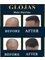 ​Glojas Hair Transplant Specialist - Best HairLoss - Glomac Galeria Hartamas, B-G-05, Jalan 26A/70A,, Desa Sri Hartamas, Kuala Lumpur, 50480,  9