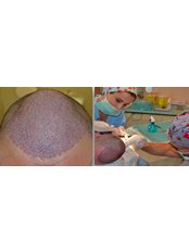 Hair Transplant - DHI-Direct Hair Implantation
