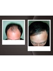 Direct Hair Implantation - DHI-Direct Hair Implantation