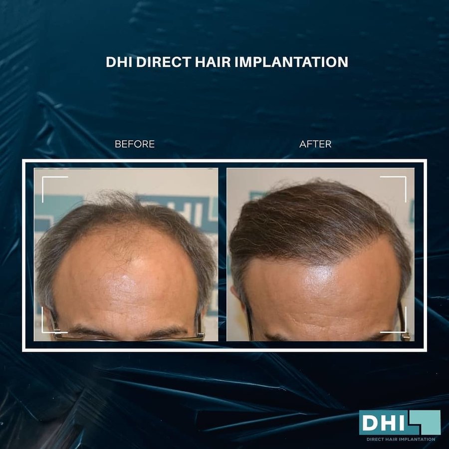 DHI-Direct Hair Implantation in Petaling Jaya, Malaysia • Read 15 Reviews