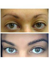 Eyebrow Transplant - Dr Shah Hair Clinic
