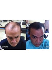 Treatment for Male Pattern Baldness - Dr Shah Hair Clinic