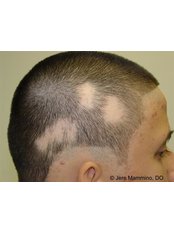 Bald Spot Removal - Dr Shah Hair Clinic
