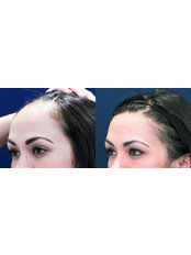 Treatment for Female Pattern Hair Loss - Dr Shah Hair Clinic