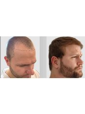 FUE - Follicular Unit Extraction - Cancun Hair Restoration