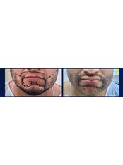 Beard Transplant - Perfect Hair