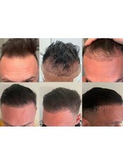 FUE - Follicular Unit Extraction - Perfect Hair