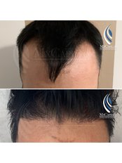 Hair Transplant - Mxcapilar