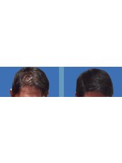 Hair Transplant - Timeless Hair & Skin Medcenter