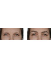 Eyebrow Transplant - Capilar Hair Center