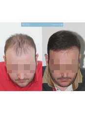 Hair Loss Consultation - 101 Hair Clinic
