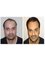 My Hair Clinic - Results after FUE hair transplantation. See more at myhairclinic.com 