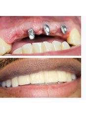 Dental Implants - Hash Clinics