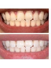 Teeth Whitening Treatment - Hash Clinics
