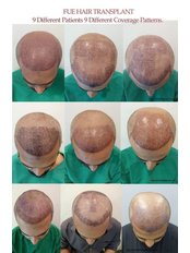FUE - Follicular Unit Extraction by Dr Bilal Ahmed Khan - Cosmeticure