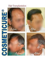 Hair Transplant by Dr Bilal Ahmed Khan - Cosmeticure
