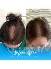 Treatment for Female Pattern Hair Loss - İHT CLİNİC