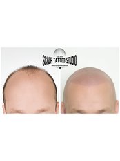 Hair Loss Specialist Consultation - Scalp Tattoo Studio