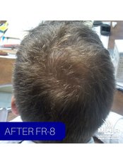 Follicular Regeneration (FR-8) - Medical Hair Restoration
