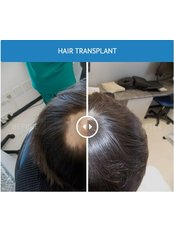 FUT - Follicular Unit Transplant - Medical Hair Restoration
