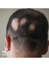 Traction Alopecia - Medical Hair Restoration