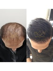 FUE - Follicular Unit Extraction - Hair Of Africa