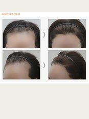 Dr.Ahn Hair Transplant Clinic - Female Hairline correction