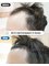 Dream Hairline Hair Transplant - 567-23 Sinsa-dong, Gangnam-gu, Seoul,  21