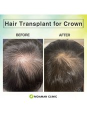 Hair Transplant - Moaman Hair Transplant Clinic