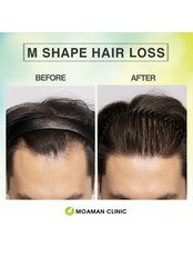 Hair Transplant - Moaman Hair Transplant Clinic
