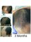 Bangkok Hair Solutions - FUT 3500 graft 