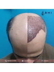 Hair Transplant - BHI Clinic salaya