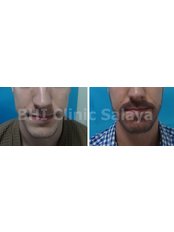 Beard Transplant - BHI Clinic salaya