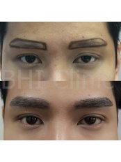 Eyebrow Transplant - BHI Clinic salaya