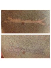 Scar Camouflage tattooing - MSP Clinic