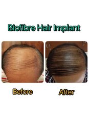 Treatment for Male Pattern Baldness - Rinrada  Cosmetic & Plastic Surgery Clinic Pattaya