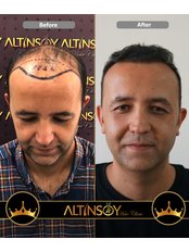 Hair Transplant - Altınsoy Hair Clinic
