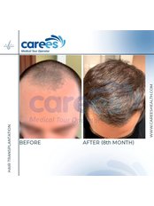 Hair Transplantation - Carees Hair Clinic